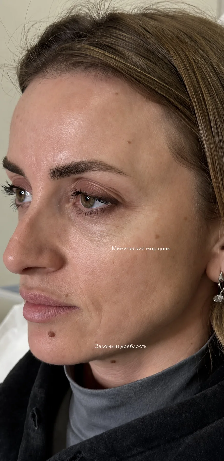 🗓️ЯНВАРЬ 2026
Мы начали работать над качеством кожи.

💉Начали делать курс коллагенотерапии препара