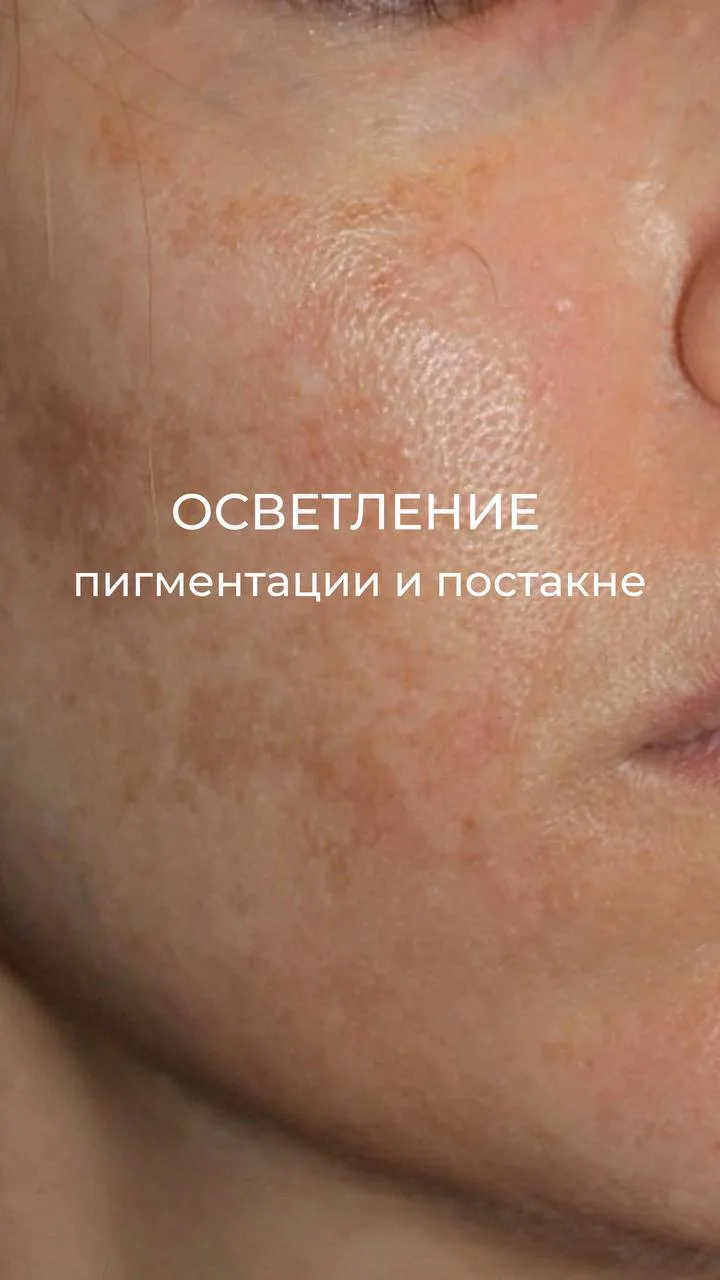 😞Пигментация и следы постакне — одни из самых частых запросов в уходе за кожей.