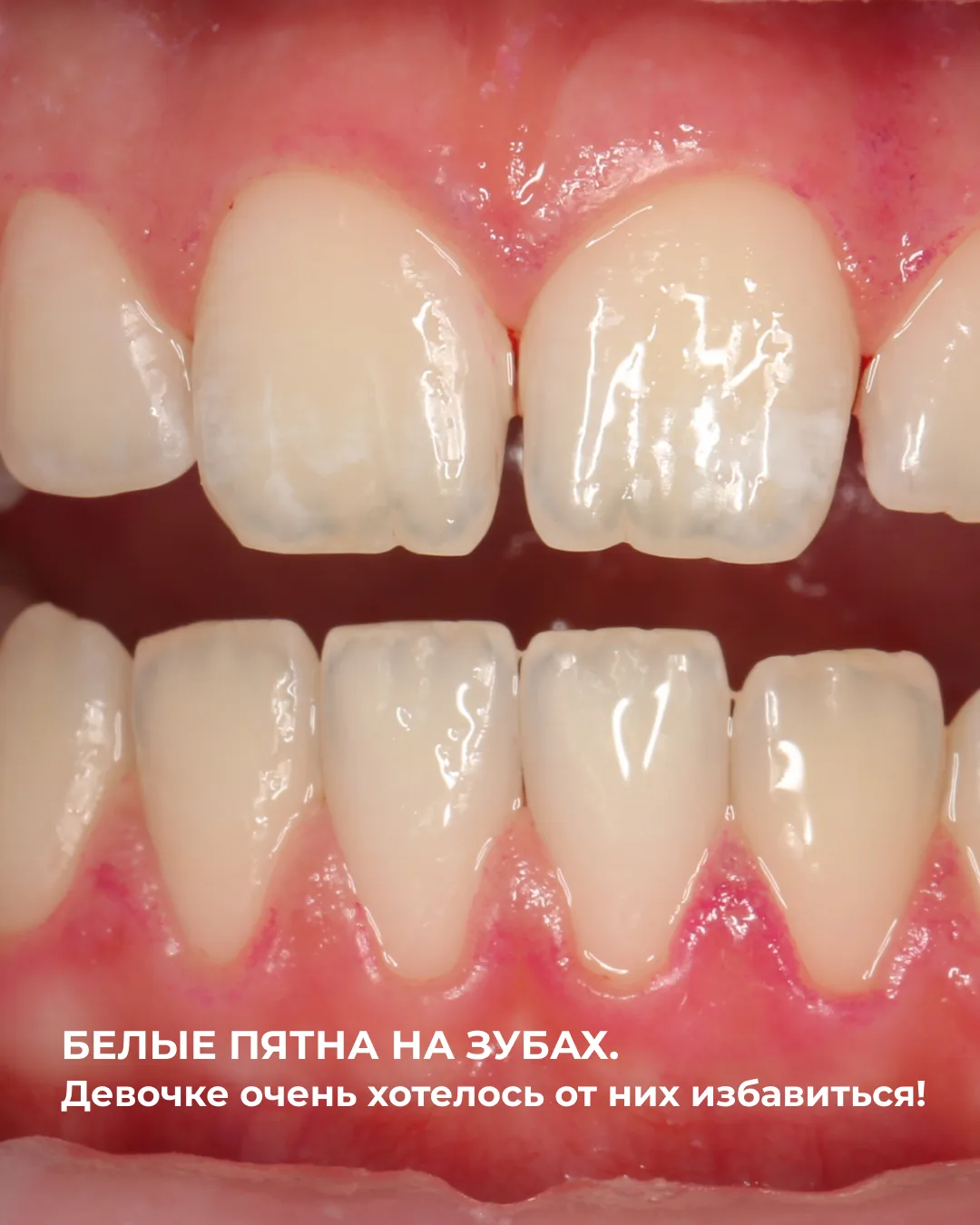 Устраняем дисколорит зубов за одну процедуру! Как это возможно? Сейчас расскажу! Пациентке 11 лет. Б