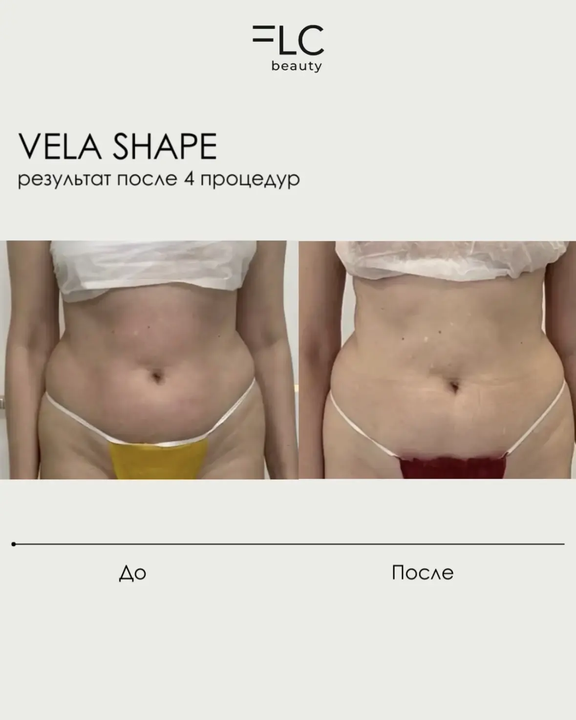 Может ли Vela Shape заменить спорт?
Всё зависит от цели: просто подтянуть фигуру или нарастить мышеч