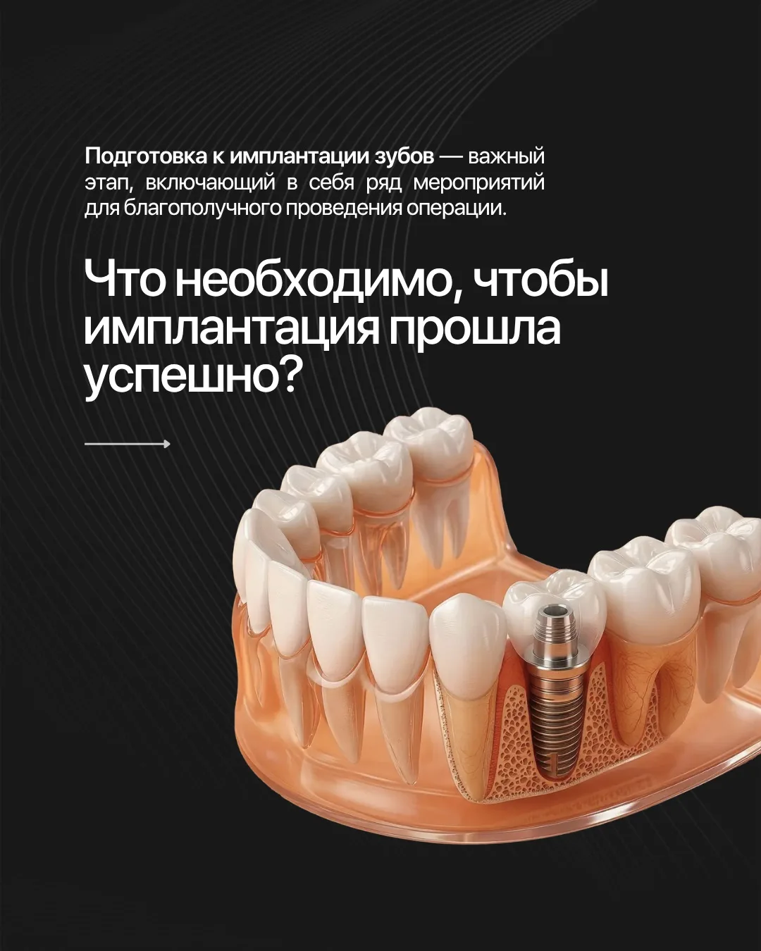 Имплантация и восстановление после неё пройдут на все 100%, если придерживаться рекомен...