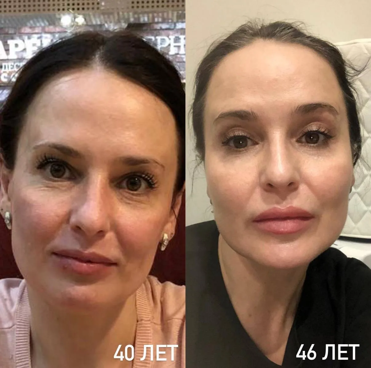 На всех фото прошло от 4 до 6 лет, а пациентки стали только моложе 😱😱😱

‼️Открывайте фото, на них