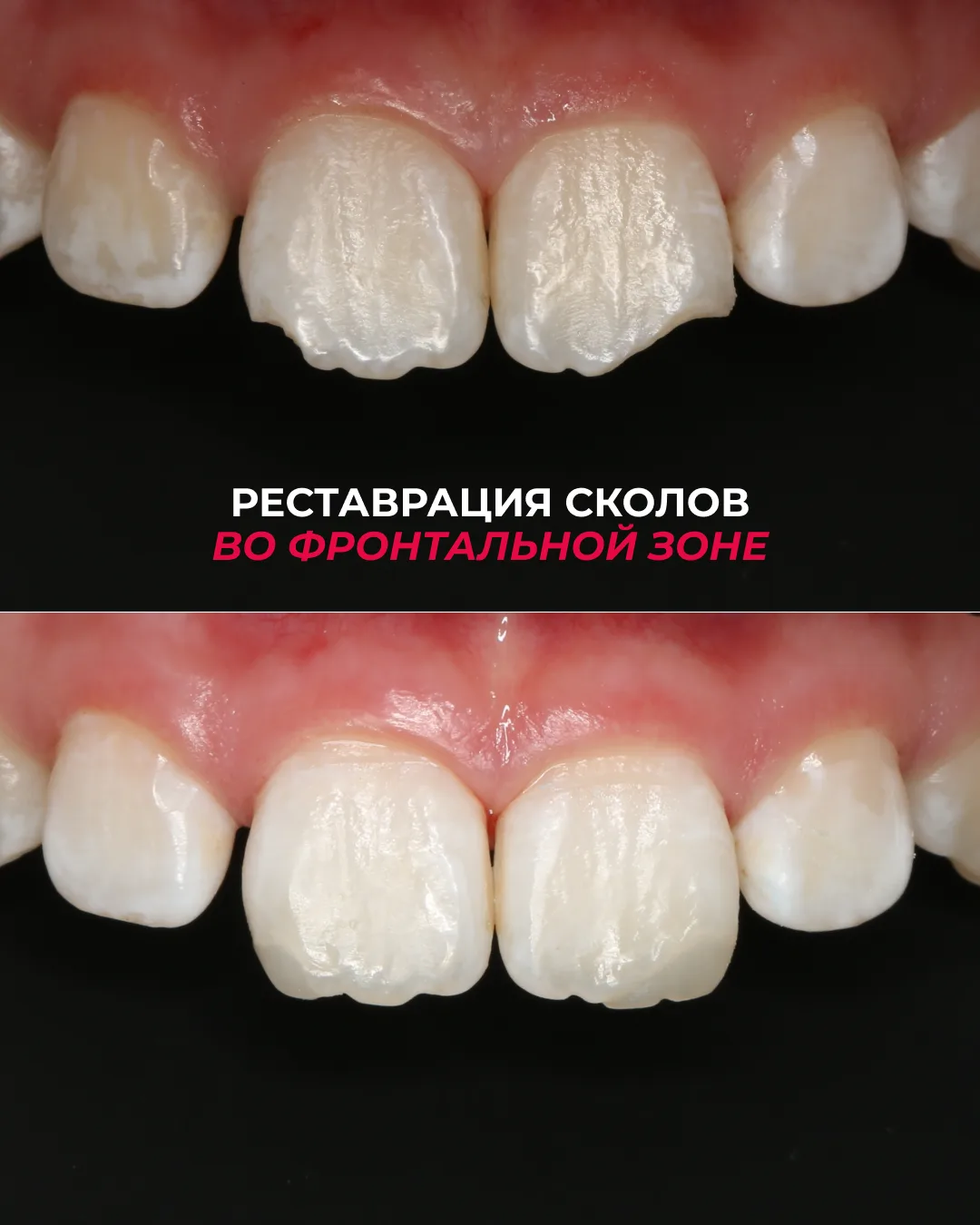 У юной пациентки сколы на обоих центральных резцах.