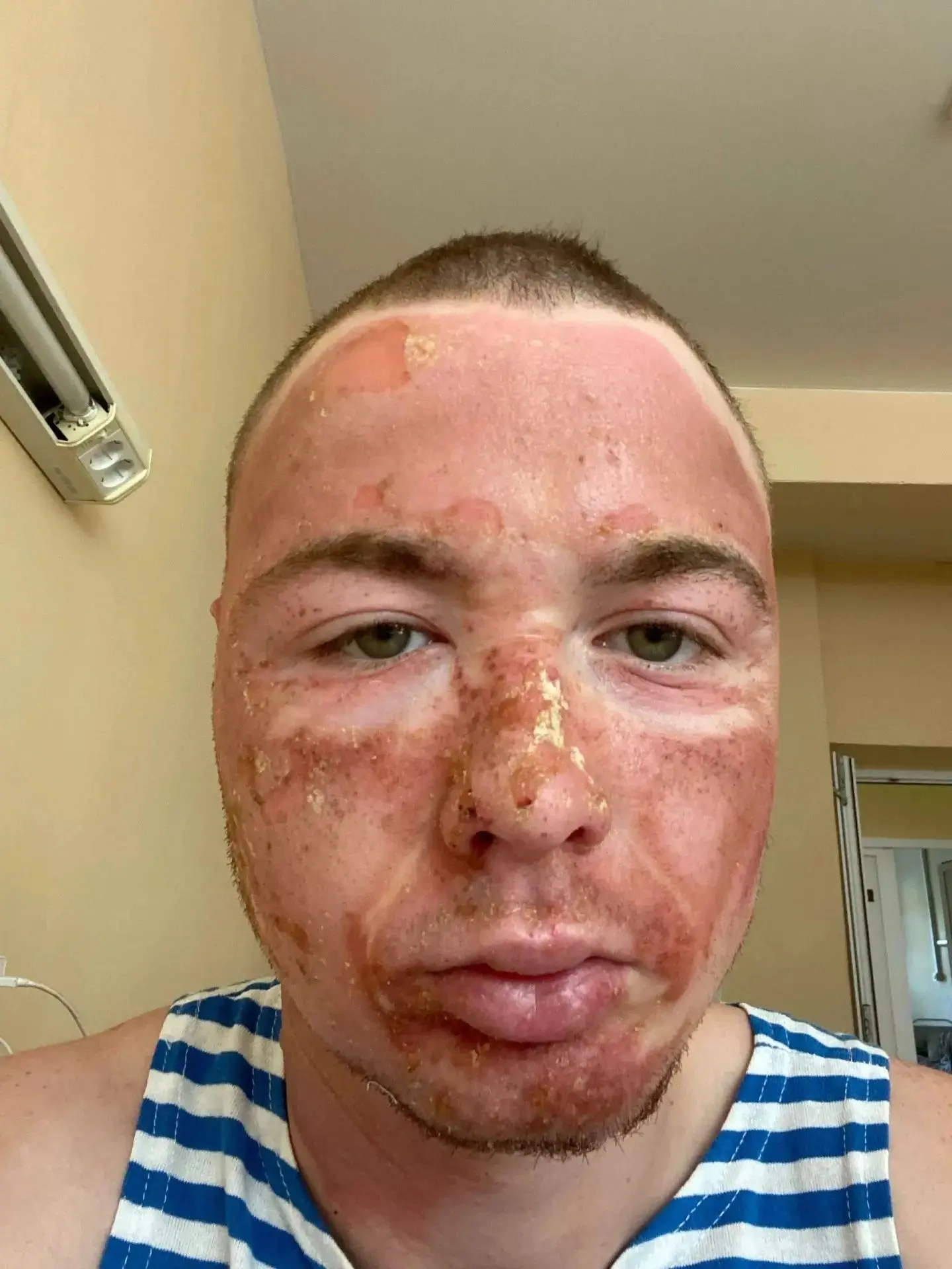 Молодой человек получил ожог 28 июня.