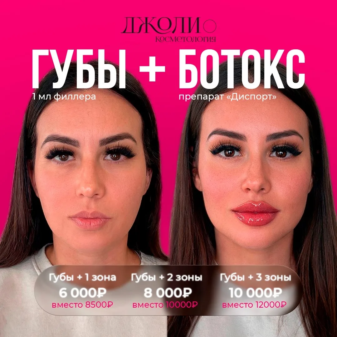 Быть моложе никогда еще не было так просто и выгодно😉💗  🔥В @jolie_cosmetology губы + ботокс (препара