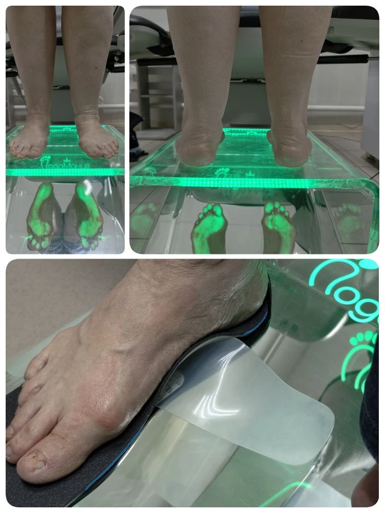 Hallux valgus (Халюс Вальгус) - это деформация переднего отдела стопы, которую чаще всего называют «