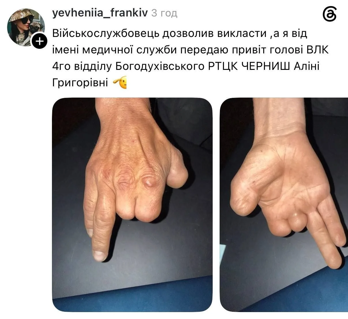 Мужчину с тремя ампутированными пальцами признали годным к службе 🫠