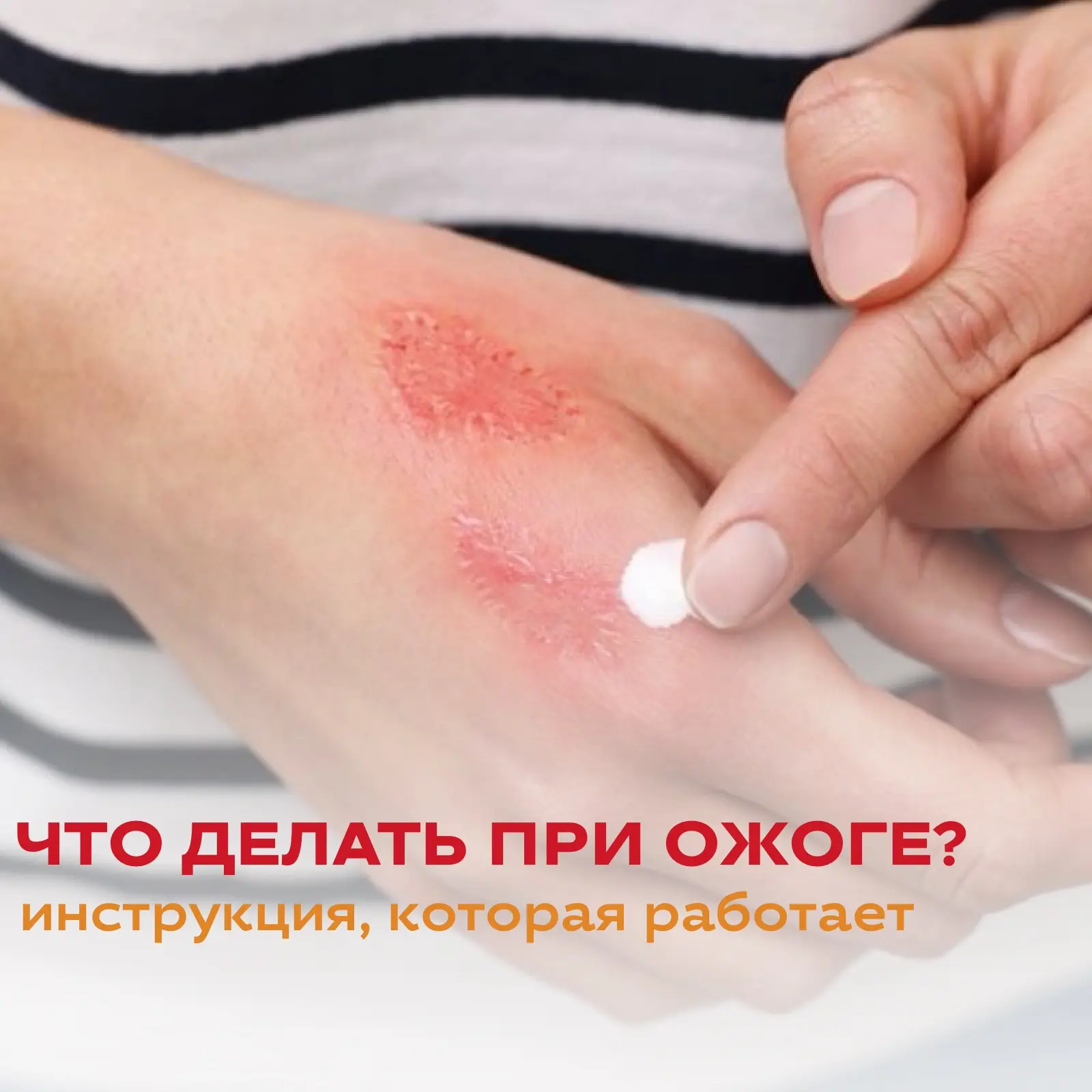 Что делать при ожоге? Инструкция, которая работает

Когда случается ожог, счёт часто идёт на секунды