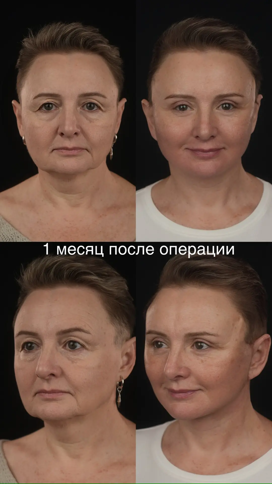 1 месяц после фейслифтинга (deep SMAS), медиальной платизмопластики, височного лифтинга...