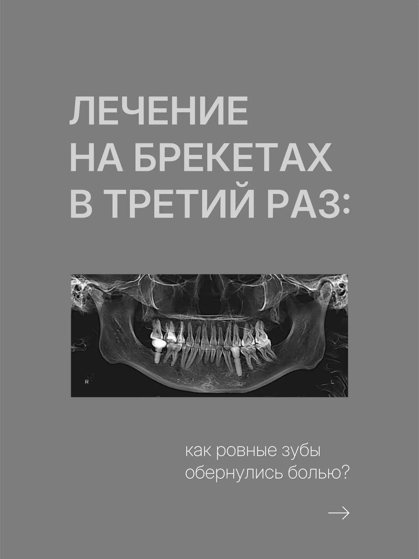Брекеты в 3-й раз: ровные зубы не гарант здоровья

История нашей пациентки поражает: она носила брек