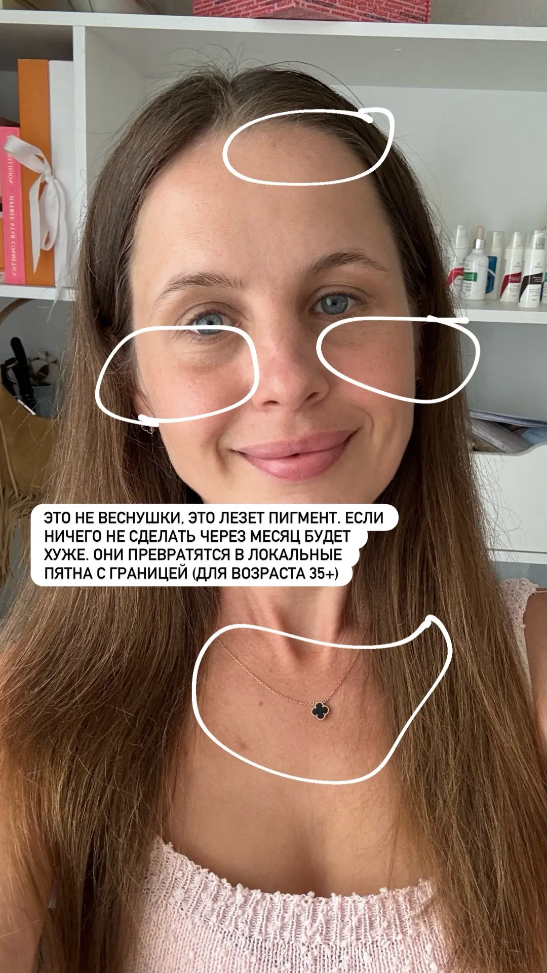 Я, как и почти все женщины 35+ в конце лета получила типичную пигментацию. Почему? Пото...