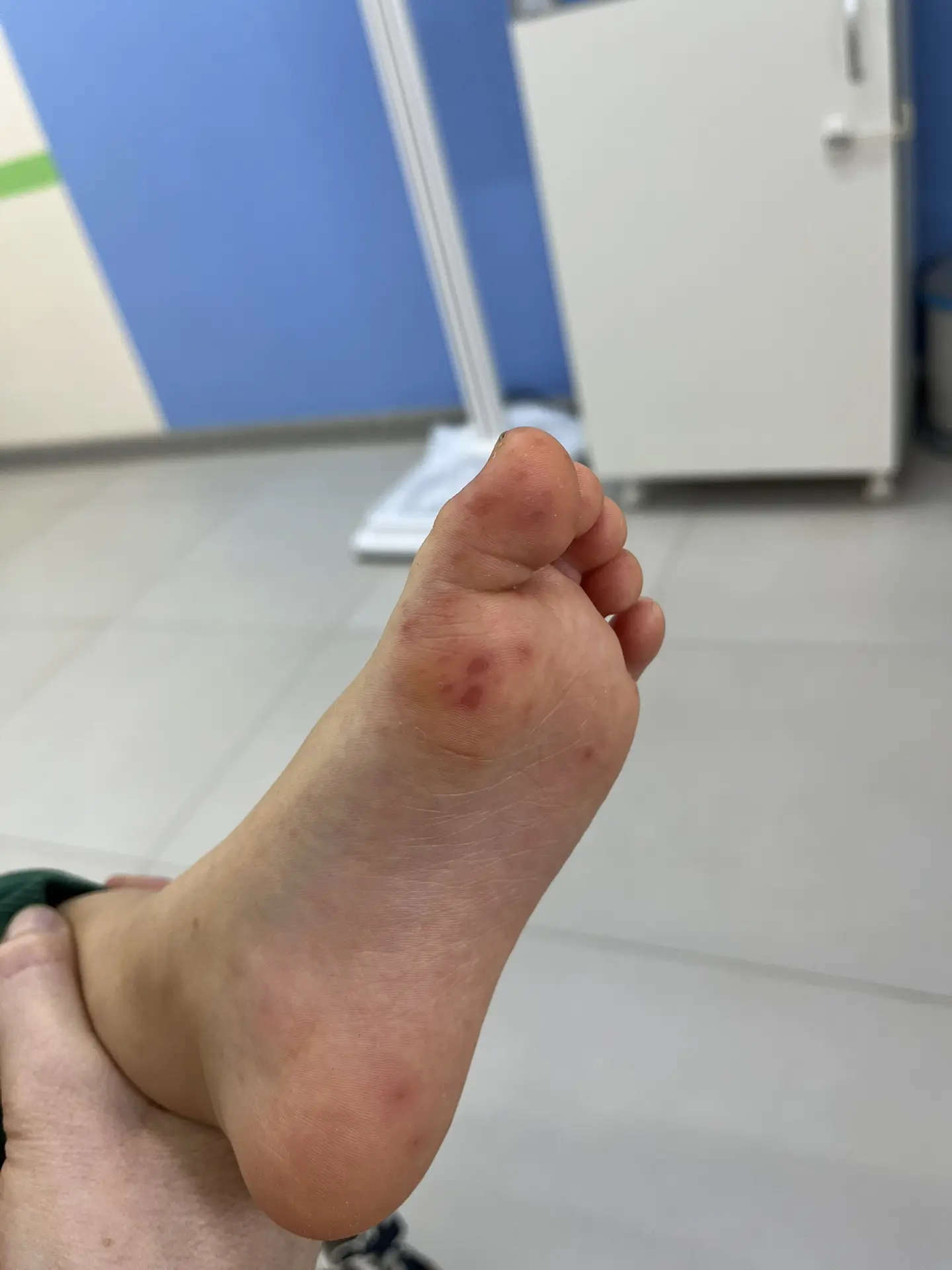 Энтеровирус Коксаки продолжается.