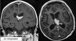🧠 В центре нейрохирургии пациентке 78 лет с тяжёлым соматическим статусом выполнили эн...