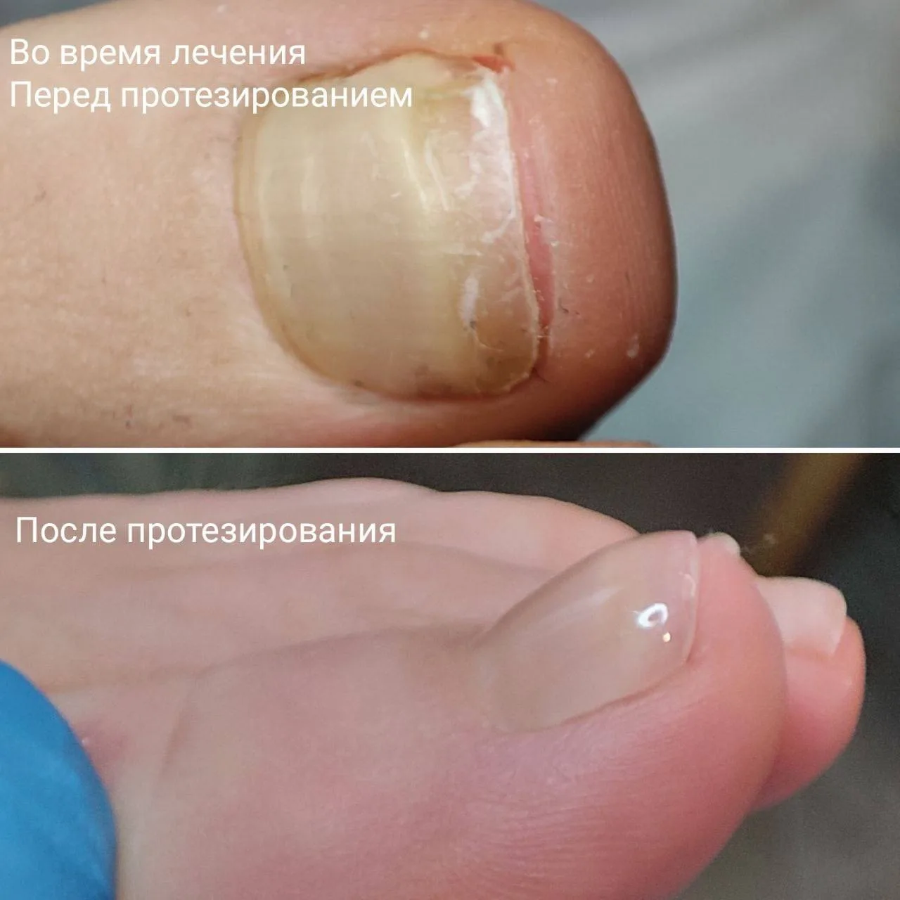 ✨ Красивые ногти - даже после травмы. Протезирование ногтевой пластины в подологии.