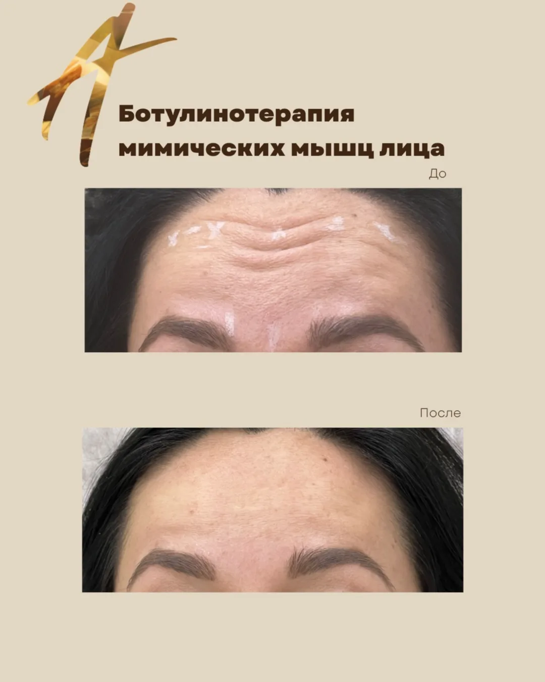 Ботулинотерапия мимических мышц лица.