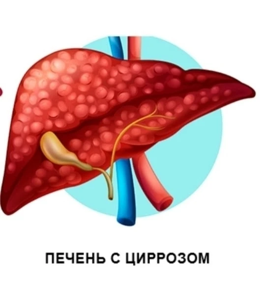 Цирроз печени - признаки