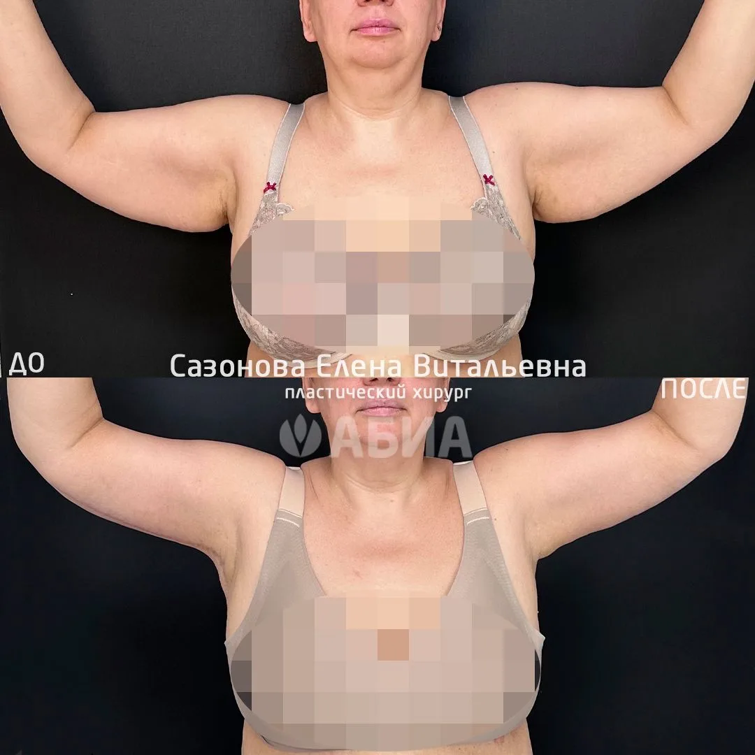 Три месяца после брахиопластики - время оценить не только изменения контура рук, но и п...