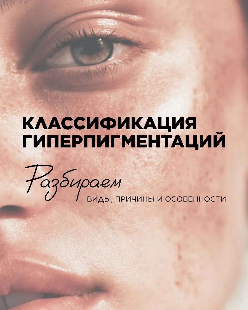 Какие виды гиперпигментации бывают? 🧬

Пигментные пятна — одна из самых частых эстетических проблем