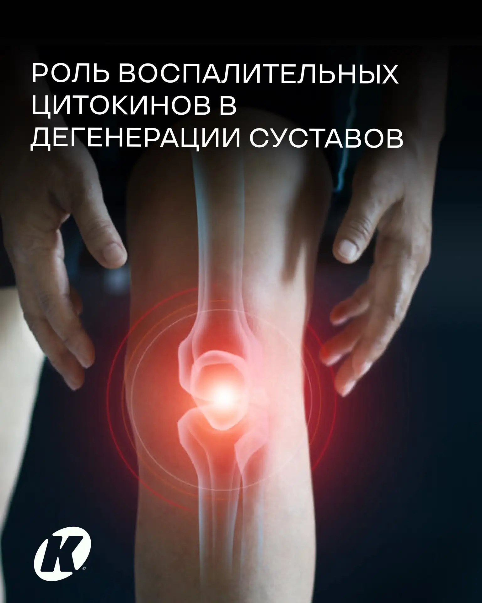 Роль воспалительных цитокинов в дегенерации суставов: почему артроз - это не просто «из...