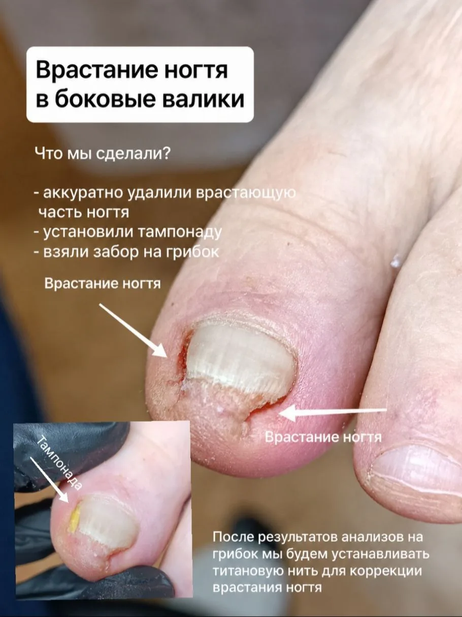 Недавно ко мне обратилась женщина с сильной болью из-за вросшего ногтя. Ходить было тяж...