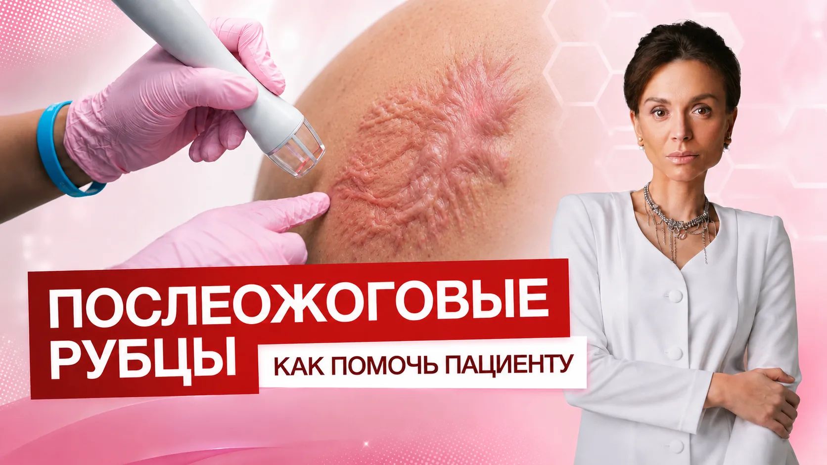 💕Новое обучающее видео: пошаговая коррекция гипертрофического рубца после ожога!