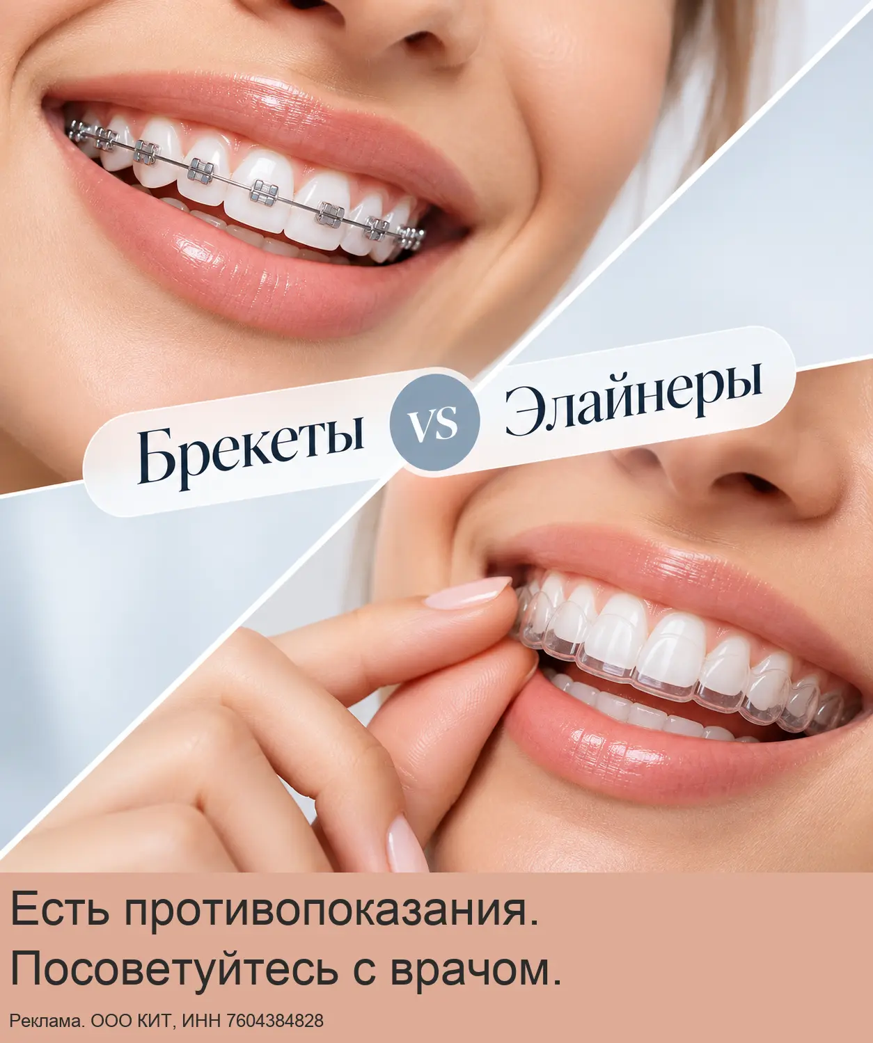 Брекеты vs Элайнеры! Что выбрать — узнайте на приёме