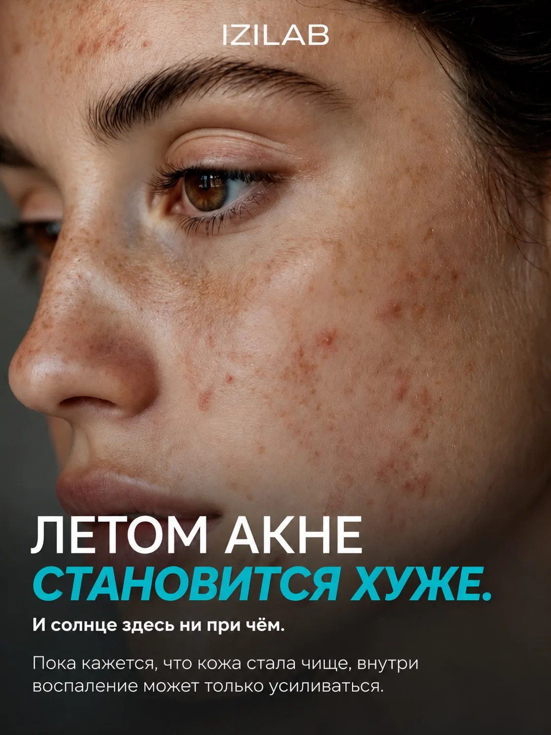 Летом акне часто становится хуже. И солнце здесь совсем не помощник

Многие замечают: на отдыхе кожа