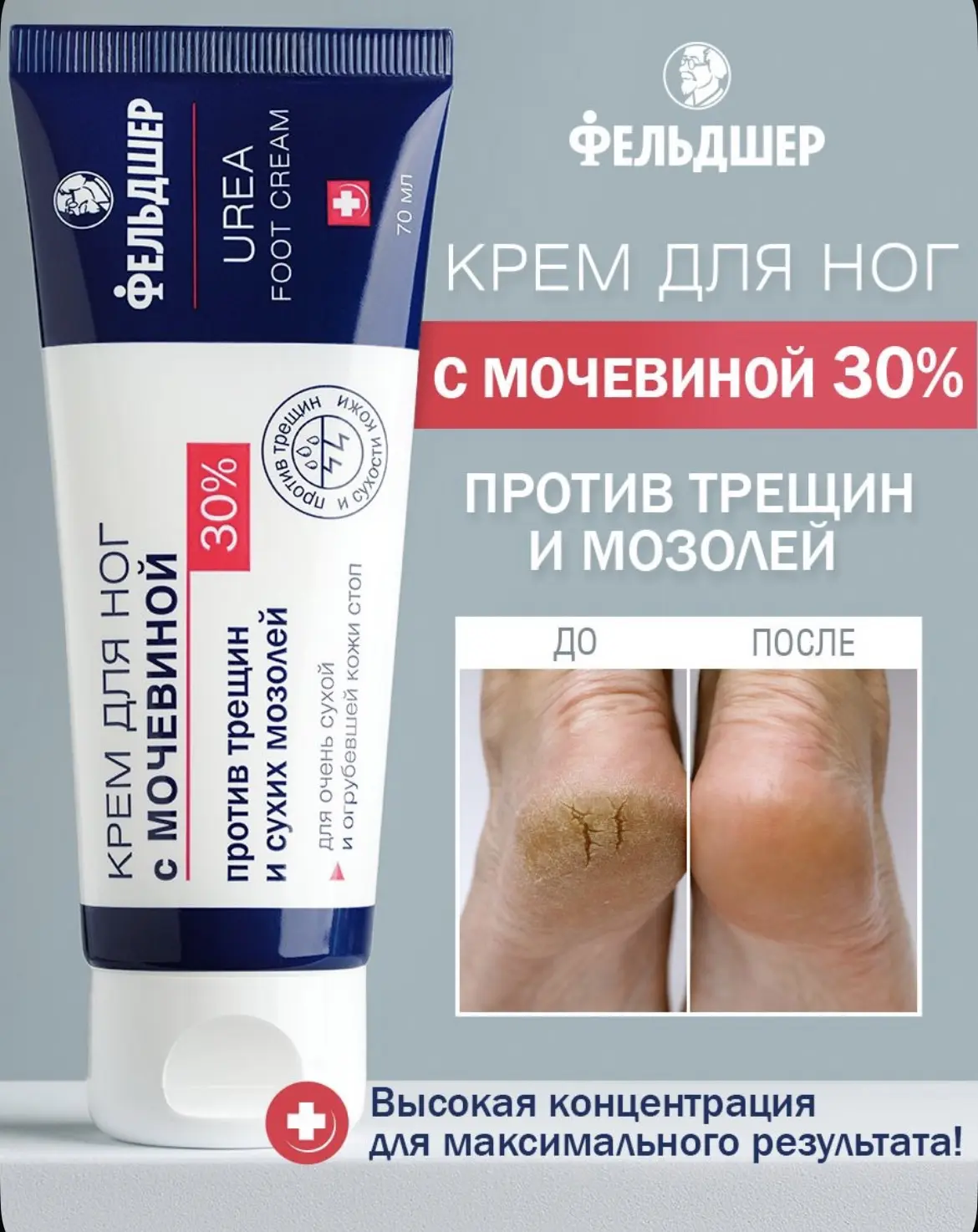 Как сохранить красоту и здоровье кожи стоп в летний сезон? Использовать средства с моче...