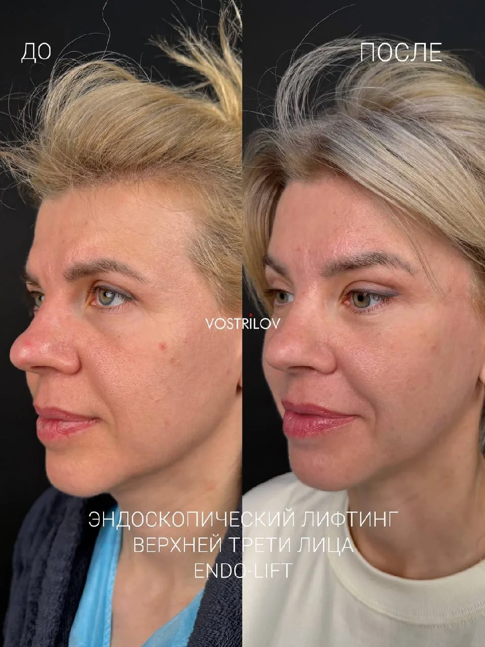 🔥1 месяц после эндоскопического лифтинга верхней трети лица с коррекцией положения бро...