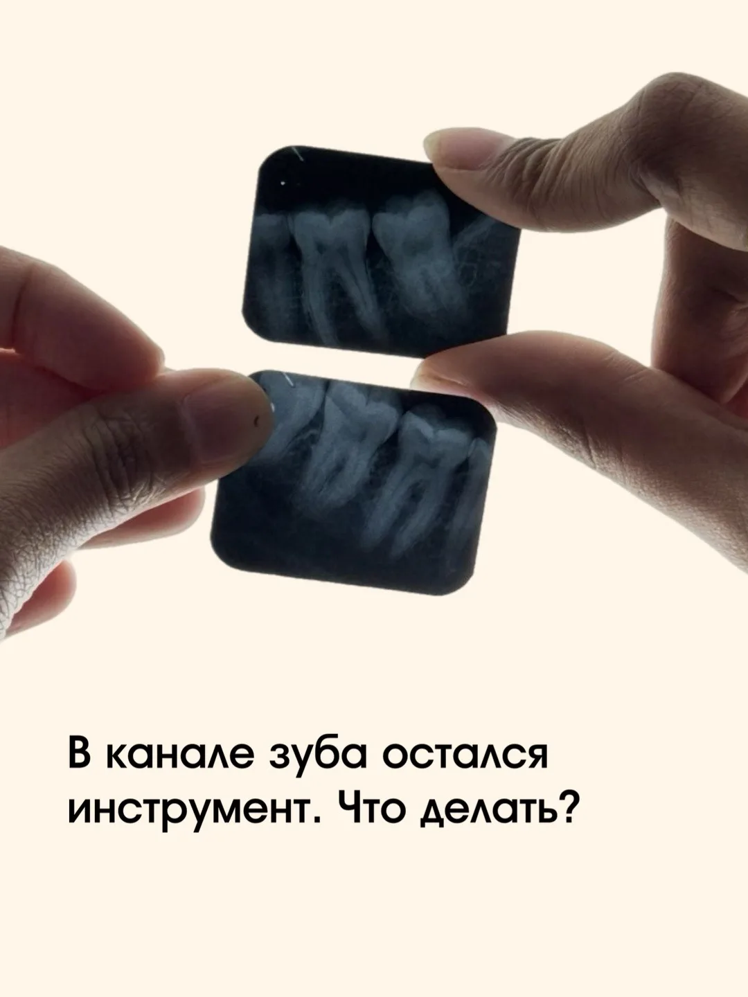 Если в канале зуба остался инструмент — это ещё не приговор для зуба.

Да, такие ситуации случаются 