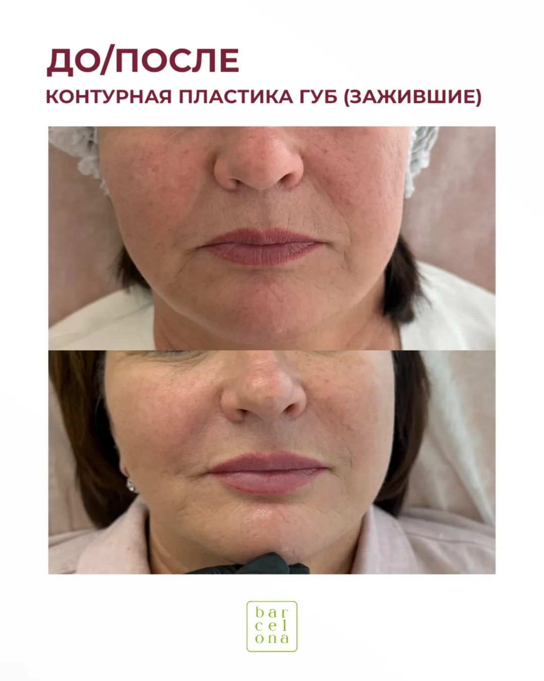 До/после: контурная пластика губ 💉