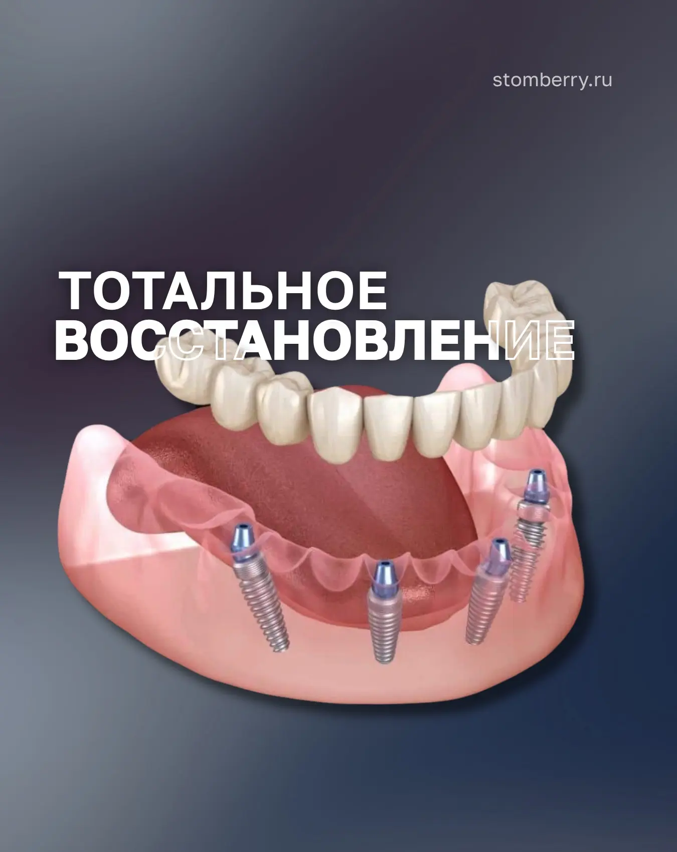 Акция: тотальное восстановление зубов.