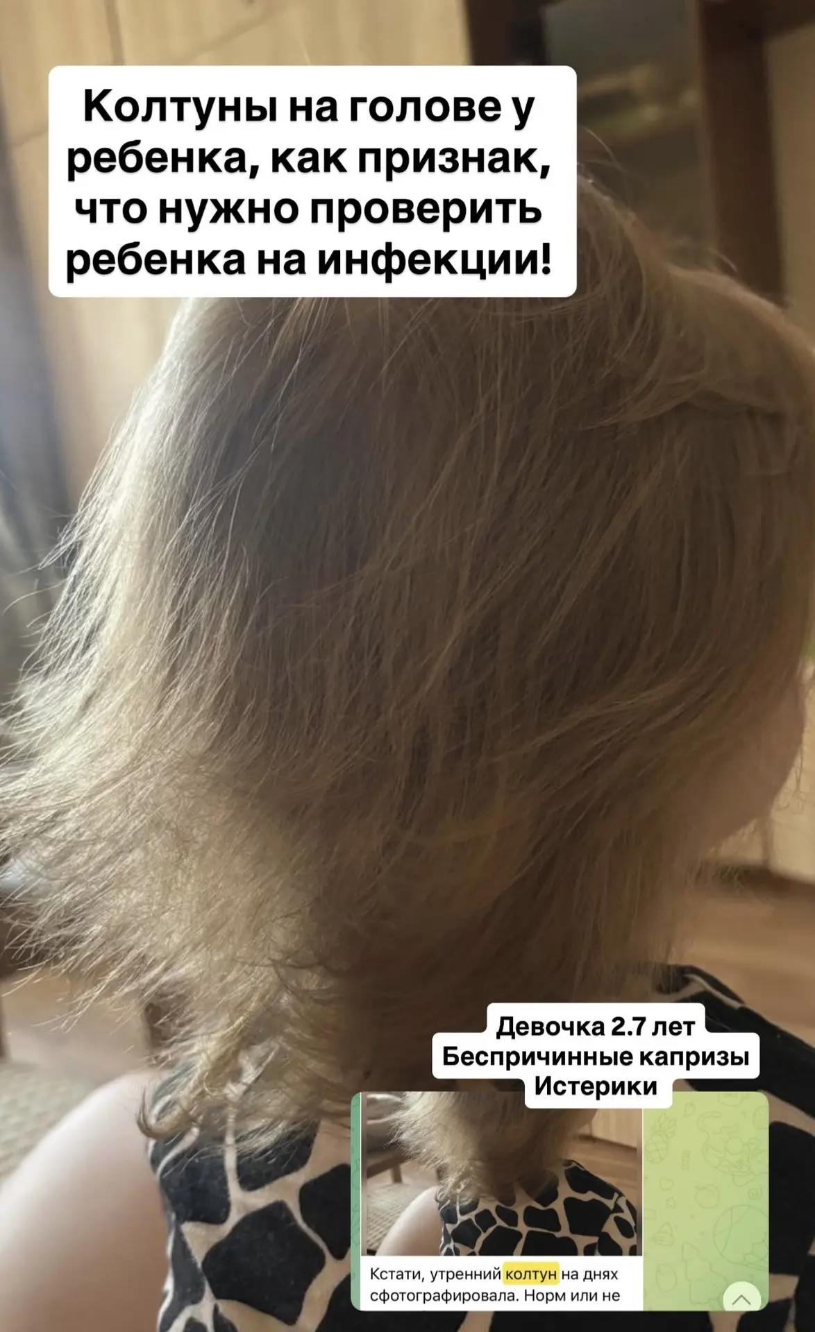КОЛТУНЫ В ВОЛОСАХ У РЕБЕНКА
Как признак, что нужно выявить инфекцию!!

Колтуны появляются чаще всего