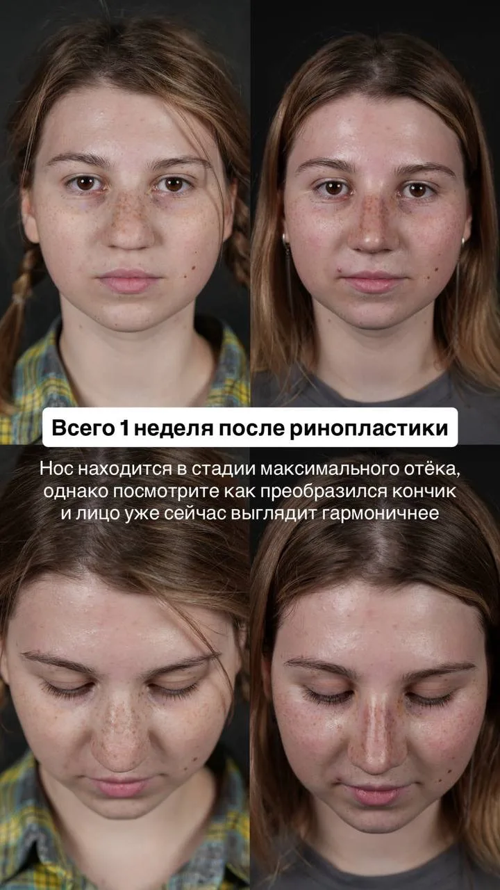 Ринопластика: гармония важнее размера