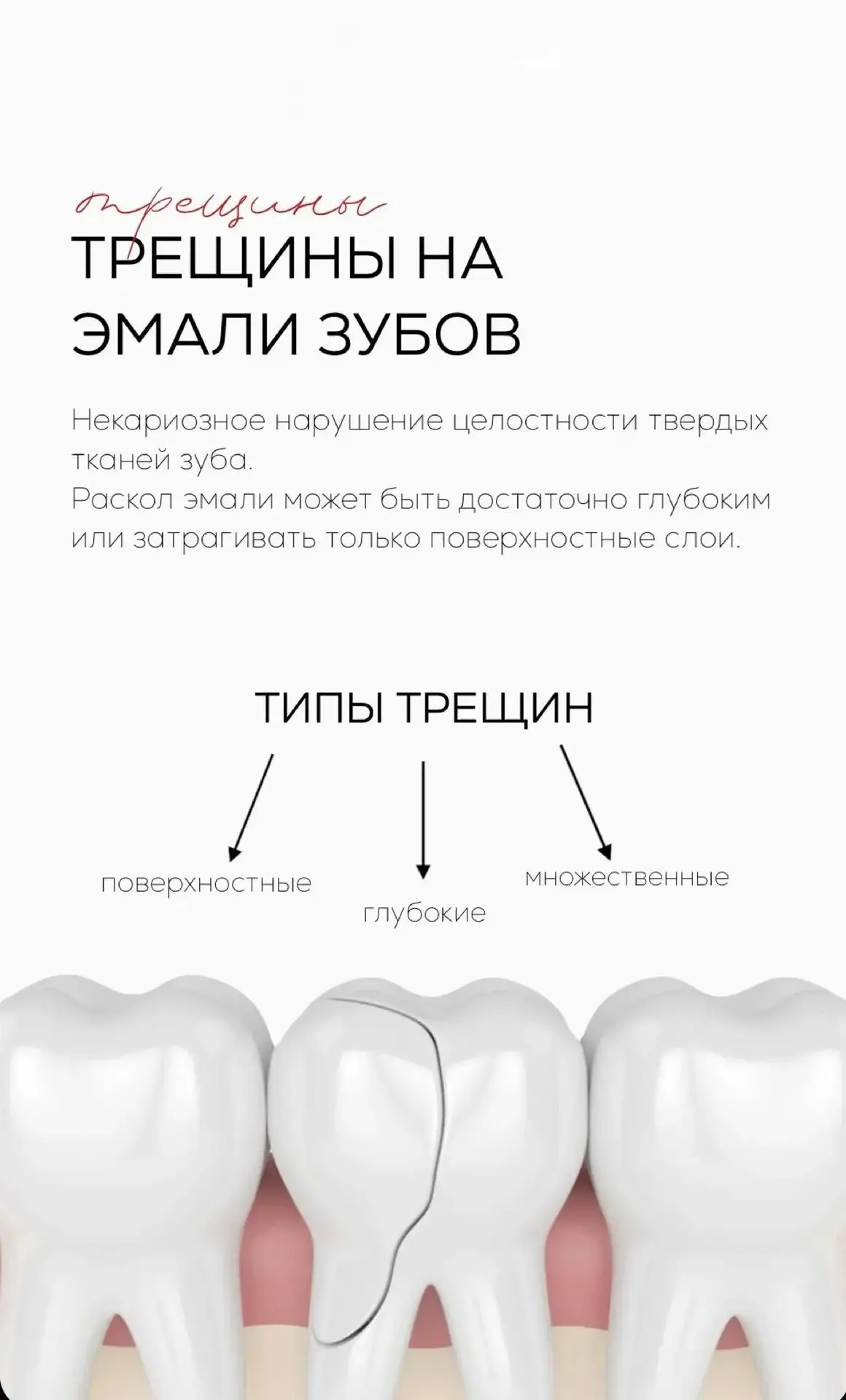 🦷 Трещины на эмали зубов: почему это серьёзно и что делать? 🦷

Многие не придают значения мелким т
