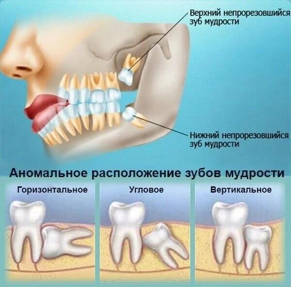Ретинированный зуб — это полностью сформированный зуб, который не прорезался в зубной р...