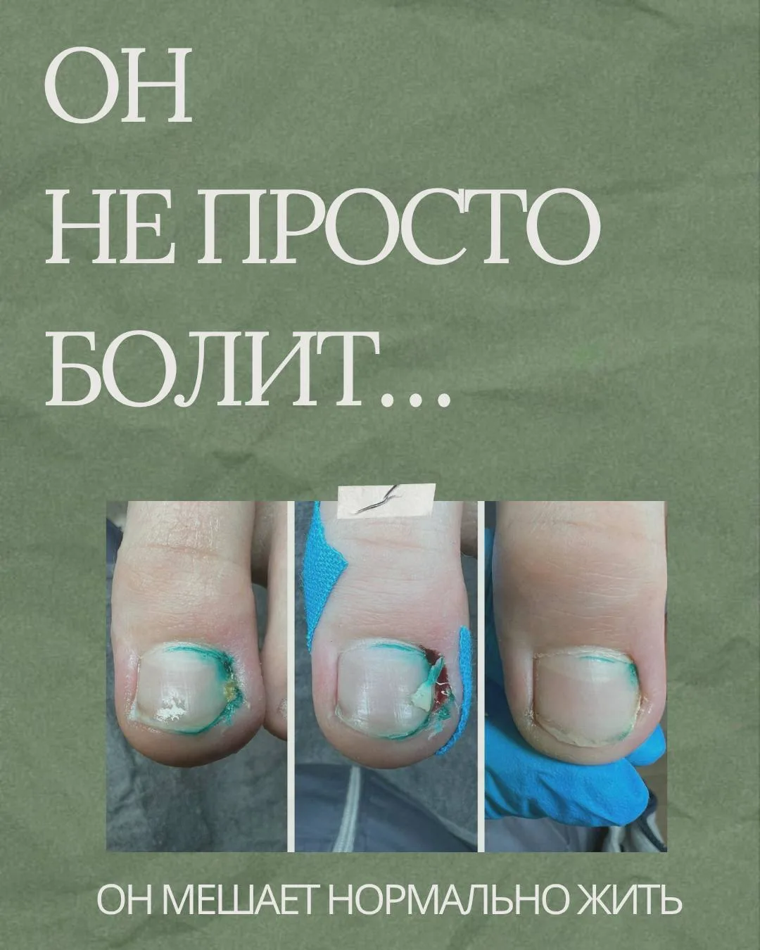 Вросший ноготь — это не «просто неудобно»  

Сначала кажется, что можно потерпеть.  

Потом становит