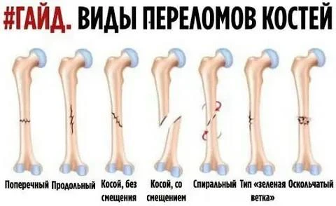 Виды переломов