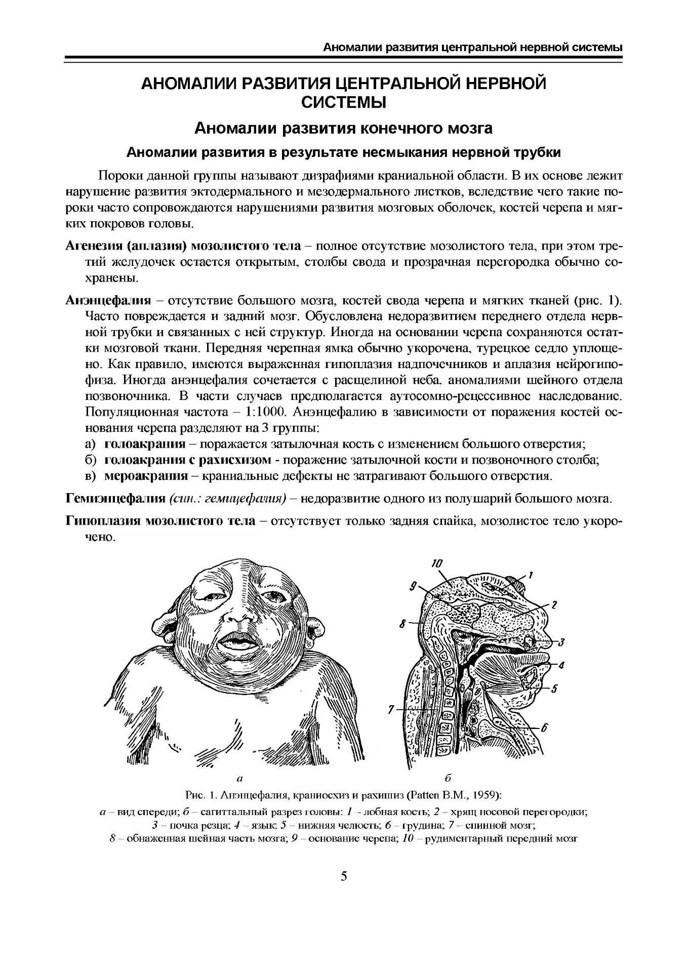 Аномалии развития ЦНС