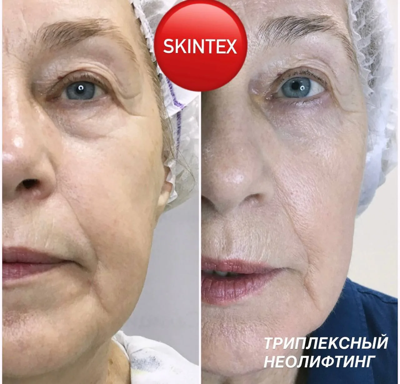 ТРИПЛЕКСНЫЙ НЕОЛИФТИНГ:
Научный прорыв в эстетической
медицине от LВМ

Устали от сложных процедур с 