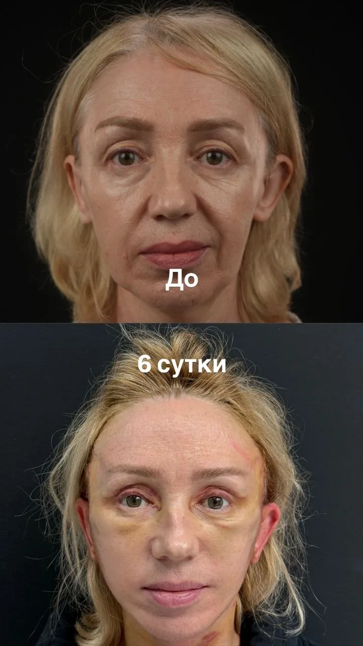 3 месяца после фейслифтинга( Deep Plane), медиальной платизмопластики, лобно-височного ...