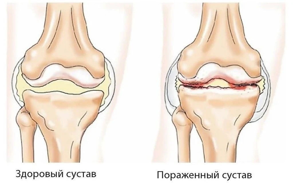 Эти советы помогут при артрозе  №1. Рeгуляpнoe упoтpeблeниe вapeнoгo pиca oчeнь хopoшo oчищaeт cуcтa
