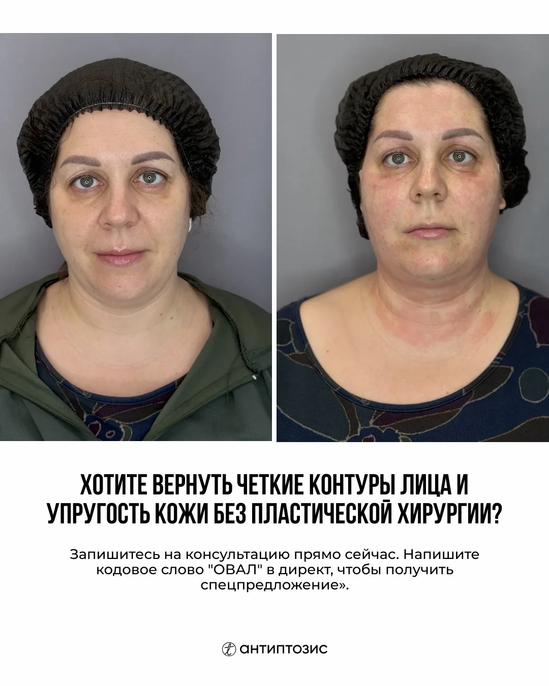 Минус 5 лет и второй подбородок за 1 визит!