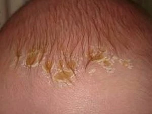 🥛 Молочные корочки у малыша: что делать?