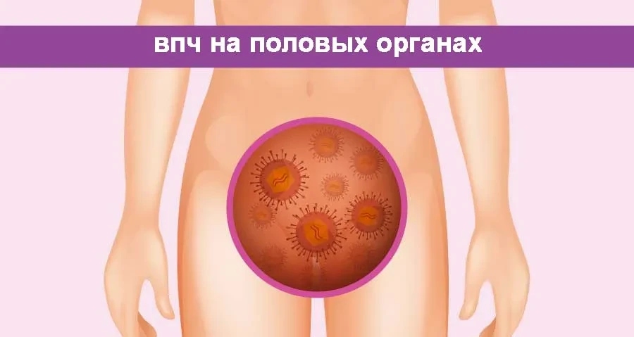 Аногенитальные (венерические) бородавки — это не только эстетическая проблема

Появление аногениталь