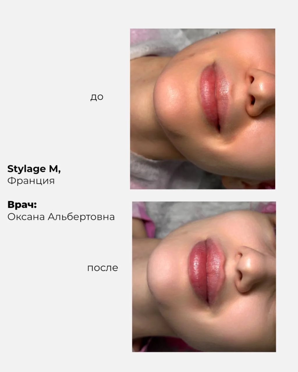 Контурная пластика губ 💋