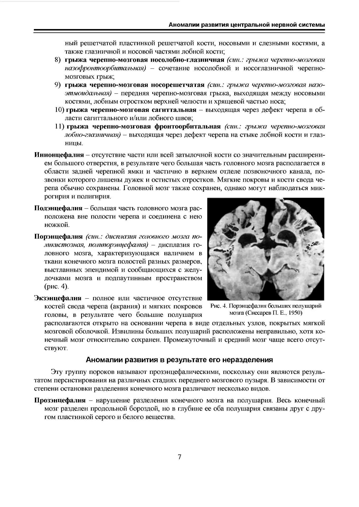 Аномалии развития ЦНС