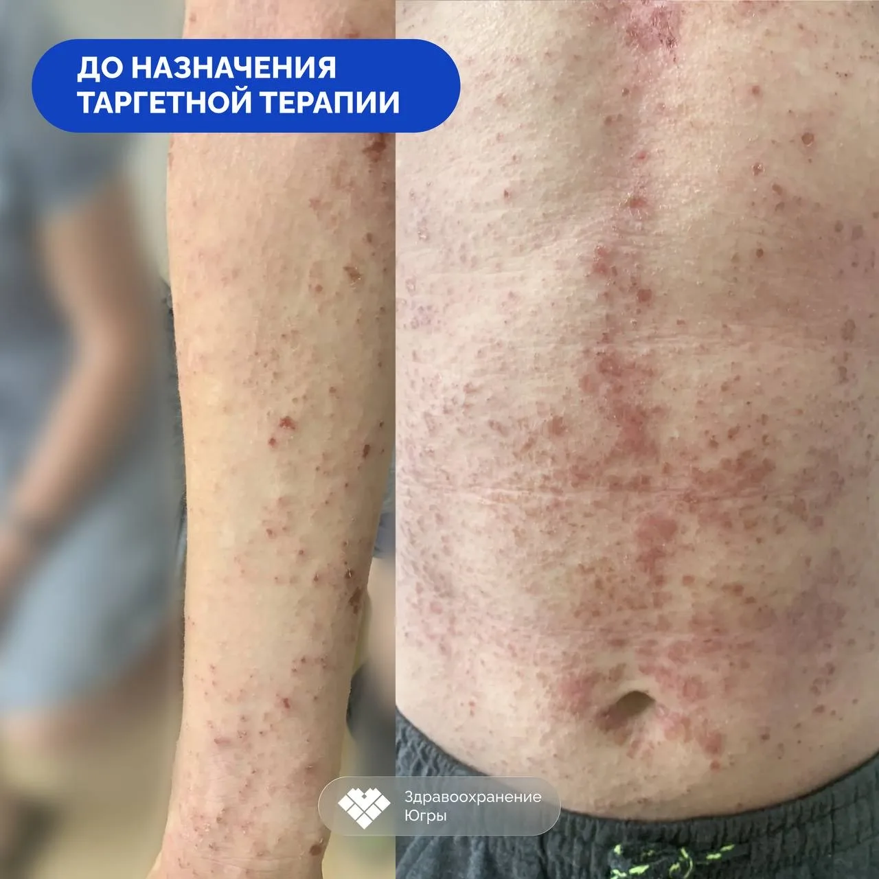 У одного из миллиона: сургутские врачи помогли подростку с редчайшим заболеванием   Медики Сургутско
