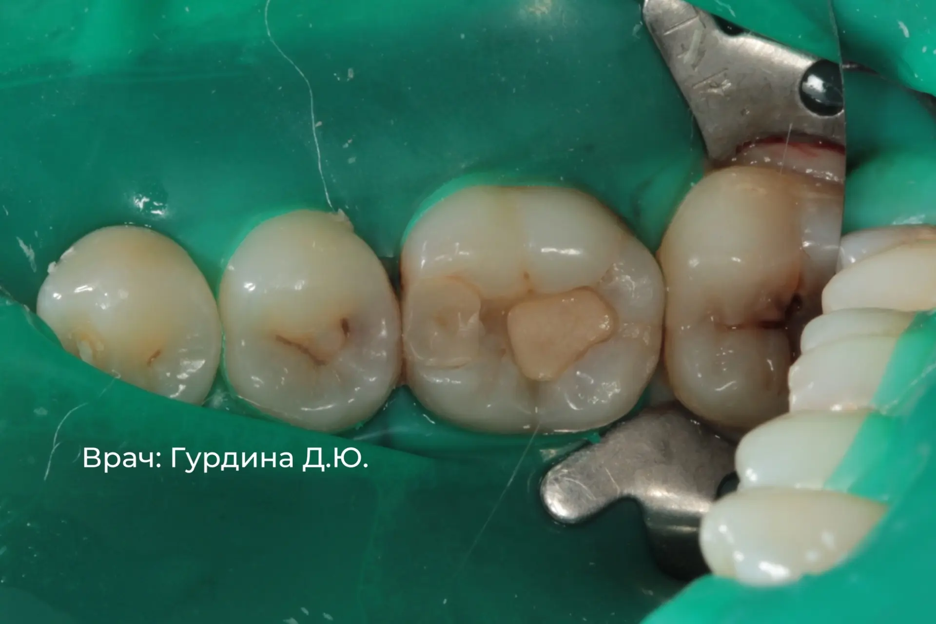 Профилактический осмотр стал спасением для зуба 🦷