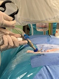 💉 Уникальная операция - эндоскопическая (Delta) декомпрессия позвоночного канала интерламинарным дос